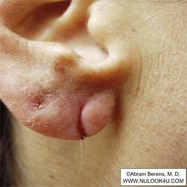 Scar revision surgery: right ear, close-up, before repair (3 of 6)