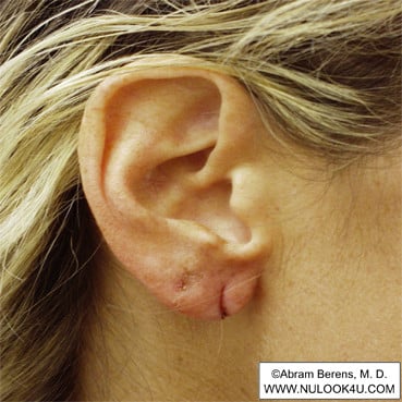 Scar revision surgery: right ear, before repair (5 of 6)