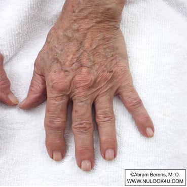 IPL photofacial treatment: left hand, before treatment (1 of 12)