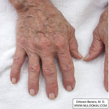 IPL photofacial treatment: right hand, before treatment (5 of 12)