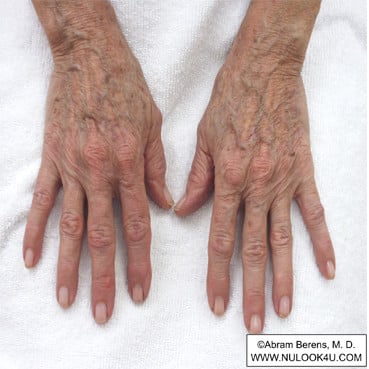 IPL photofacial treatment: right and left hands, before treatment (3 of 12)