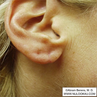 Scar revision surgery: right ear, after revision (4 of 6)