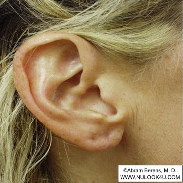 Scar revision surgery: right ear, after revision (6 of 6)