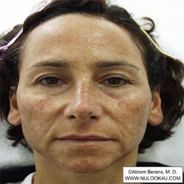 Facial rejuvenation: full face, before treatment (9 of 12)