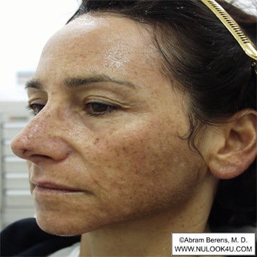 Facial rejuvenation: left side of face, before treatment (11 of 12)