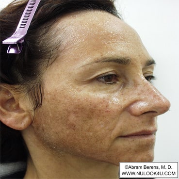 Facial rejuvenation: right side of face, before treatment (7 of 12)