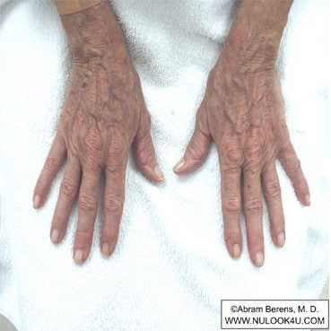 IPL photofacial treatment: bilateral hands, after 2 IPL treatments (4 of 12)