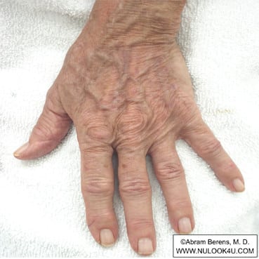 IPL photofacial treatment: left hand, after 2 IPL treatments (2 of 12)