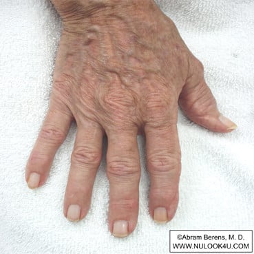 IPL photofacial treatment: right hand, after 2 IPL treatments (6 of 12)