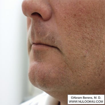 Scar revision surgery: left upper lip (1 of 6)