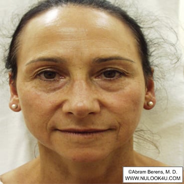 Facial rejuvenation: full face, after treatment (10 of 12)