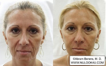 Restylane filler treatment: full face (25 of 27)