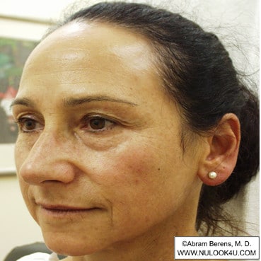 Facial rejuvenation: left side of face, after treatment (12 of 12)