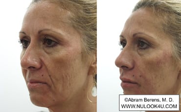 Restylane filler treatment: left side of face, after treatment (26 of 27)