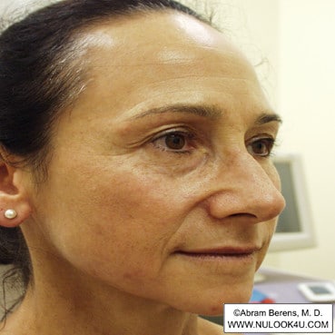 Facial rejuvenation: right side of face, after treatment (8 of 12)