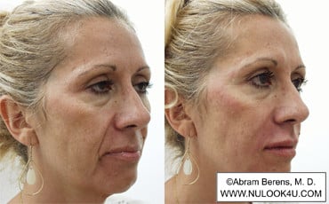 Restylane filler treatment: right side of face (27 of 27)